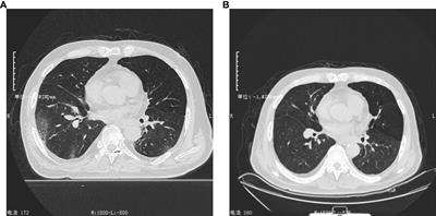 Coinfection of SARS-CoV-2 and influenza A (H3N2) detected in bronchoalveolar lavage fluid of a patient with long COVID using metagenomic next−generation sequencing: a case report